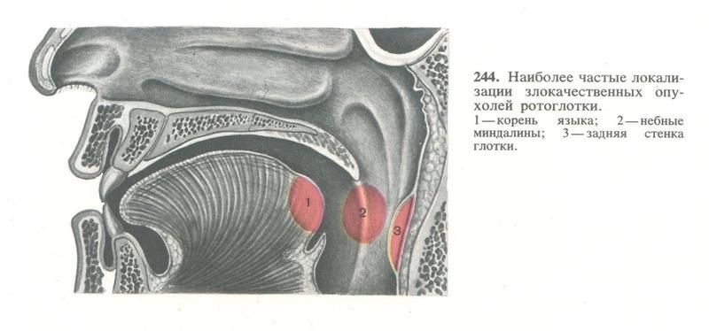 Рак гортани фото начальная стадия