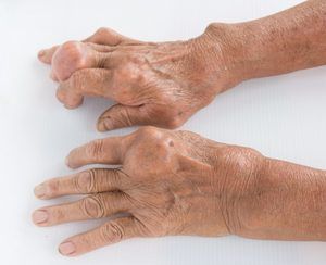 bol u srednjim zglobovima prstiju