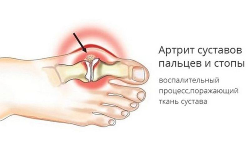 Uzroci, simptomi i liječenje artritisa stopala