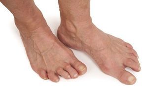 simptomi i liječenje artroze ravnog stopala)