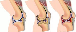 deformirajuća artroza koljena liječenje 2 stupnja