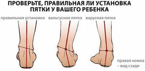 ledum artroza liječenje)