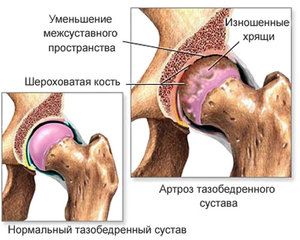 Osteoartritis