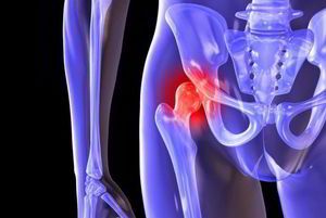 Liječenje artroze zglobova kuka kod kuće: osnovne metode i prevencija upale