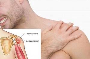 liječenje humeroskapularne artroze)