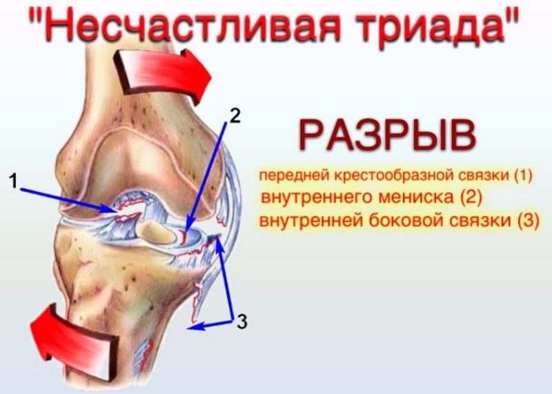 Передняя связка коленного сустава. Разрыв связок ПКС коленного сустава. Механизм травмы передней крестообразной связки коленного сустава. Разрыв связок ПКС коленного сустава коленный сустав. Разрыв связок передней крестообразной связки коленного сустава.