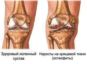 osteoartritis smrznute liječenju rame)