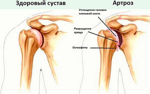 reumatoidna bol u zglobu kuka kako ublažiti bol dislokacijom zgloba