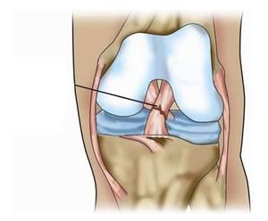 ruptura ligamenta zgloba koljena