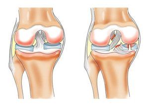 bol tijekom rehabilitacije koljena