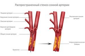 ateroskleroze donjih ekstremiteta i hipertenzije
