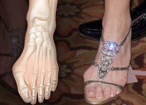 Simptomi i liječenje artroze zglobova stopala