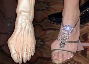 Hallux valgus – najčešća deformacija stopala