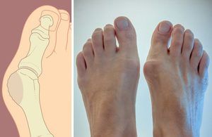 najbolje liječenje osteoartritisa stopala