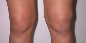 Artroza Zglob koljena pripravaka za liječenje