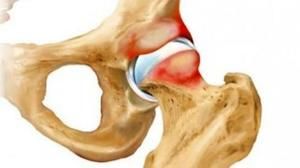 Koji je tretman propisan za artrozu zgloba kuka 3. stupnja?