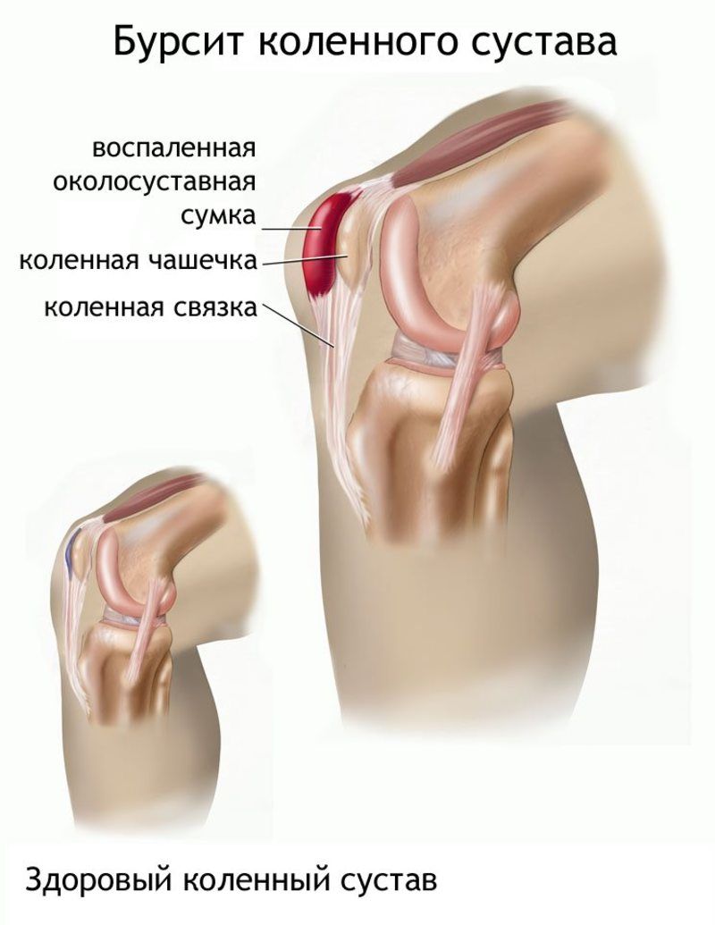 bursitis zgloba koljena kako ublažiti bol