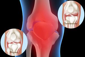 akutna bol u liječenju zgloba koljena