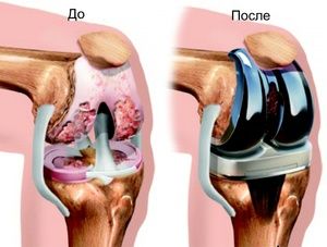bol u protezi zgloba kuka kako ublažiti akutnu bol u koljenu