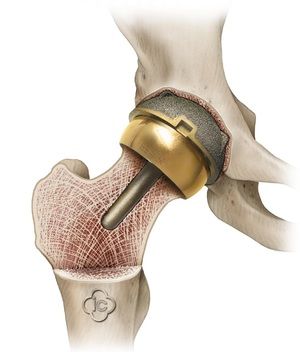 gel od boli koljena artroza 1 metatarsofalangealnog zgloba liječenja od 1 stupnja