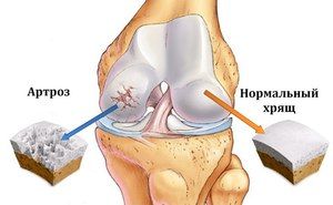 napredni tretman artroze koljena bol u zglobu kuka u bok i