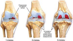 Simptomi i liječenje artroze koljena 2. stupnja