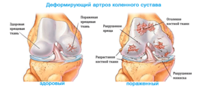 osteoartritis koljena tretira s medom