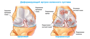 dijeta liječenje osteoartritisa