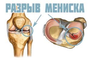 bol u zglobu koljena nakon uklanjanja meniskusa)