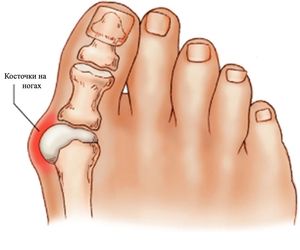 Zašto boli kost na strani velikog nožnog prsta: uzroci, simptomi i liječenje