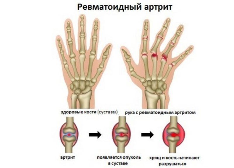 liječenje deformirajuće artroze na prstima