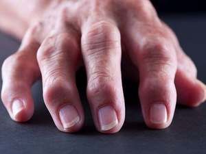 Artroza i gonoartroza: Simptomi, uzroci i lečenje
