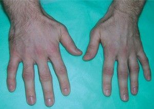 metatarsofalangealna artroza liječenja od 1 prsta