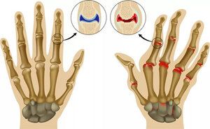 u git liječenju artroze prstiju