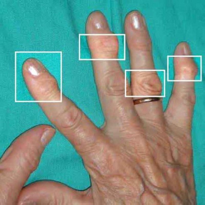 liječenje artroze ruku i prstiju)