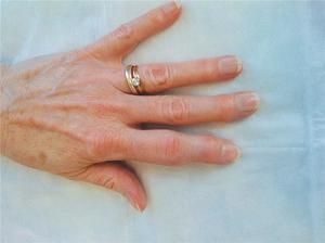 metatarsofalangealna artroza liječenja od 1 prsta