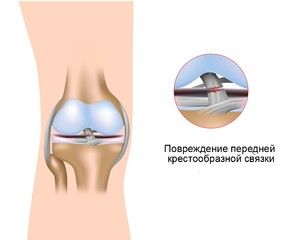 injekcije koje se koriste u liječenju artroze)