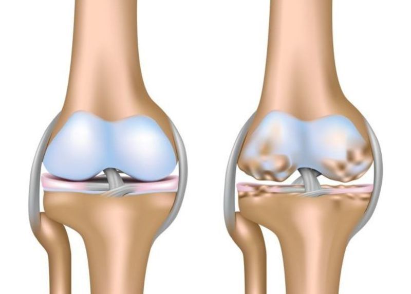 bol u zglobu koljena 3 stupnja artroza liječenje folija