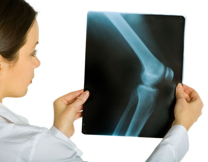 Kako liječiti artroza koljena kod kuće: liječenje na mnoge načine