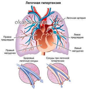 plučna hipertenzija