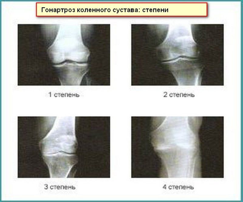 artroza liječenja zgloba koljena 2 stupnja
