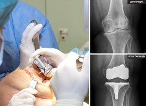 bol nakon operacije zamjene koljena)