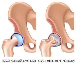 Metode za prevenciju artroze koljena - Masaža - 