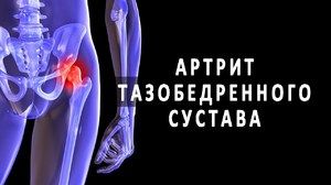 liječenje artroze u češkoj košta