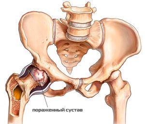 osteopatija u liječenju artroze zgloba kuka