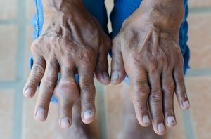 giht liječenje artritisa