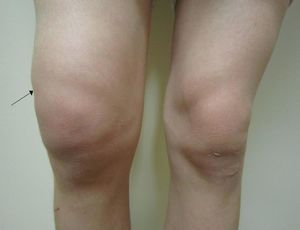 burdock za bolove u zglobu koljena masti za bolove u zglobovima i tetivama