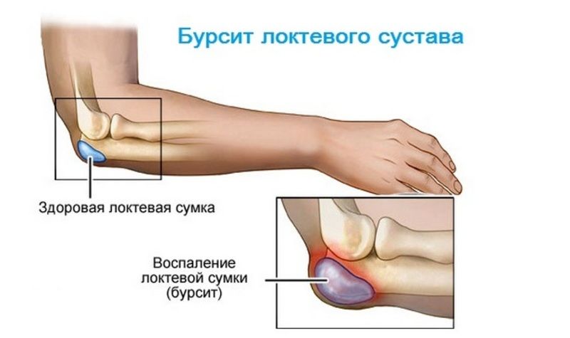 elektroforeza boli u zglobovima)