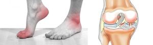 liječenje artroze 2. stupnja na stopalu liječenje artroze hidrogen peroksidom