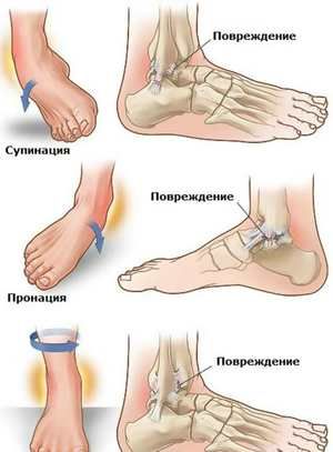 djelotvoran lijek za bol u zglobu gležnja)